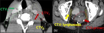 Reproducibility and Repeatability of CBCT-Derived Radiomics Features